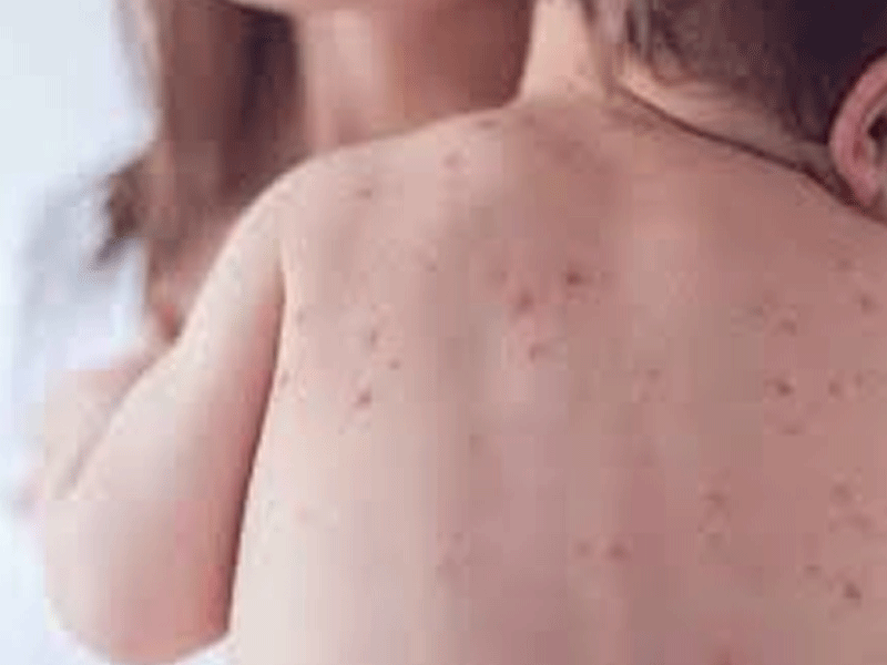 সিলেটে হাম উপসর্গে আরও ১ শিশুর মৃত্যু
